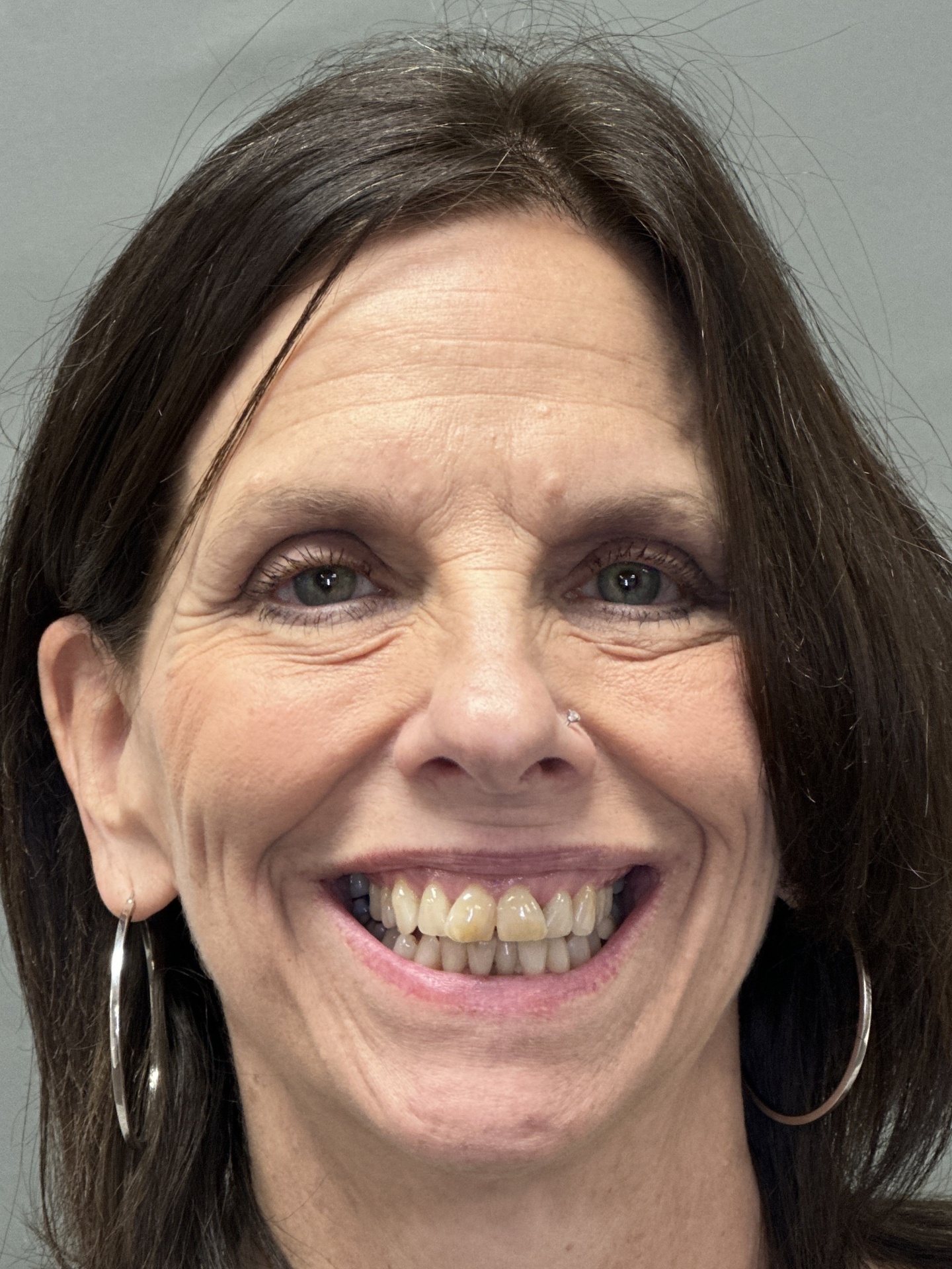 Linda E. smile before treatment at Red Lion Dental